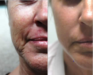 SmartXide before after