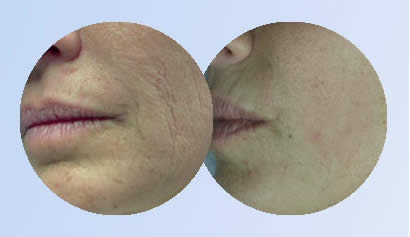 SmartXide after treatment