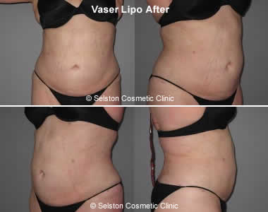 Vaser Lipo after