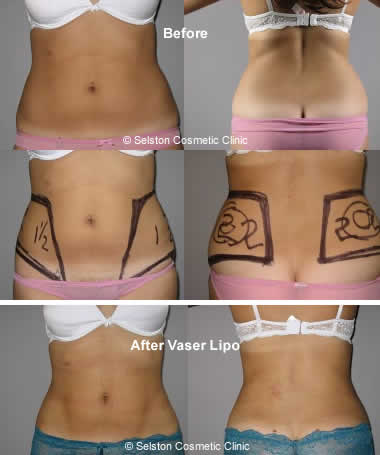 Vaser Lipo before after