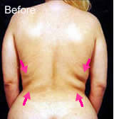 Vaser liposelection before photo