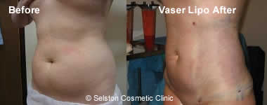 Vaser Lipo before after