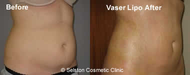 VaserMid Def before after