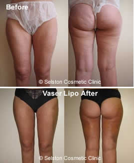 Vaser Lipo Thighs