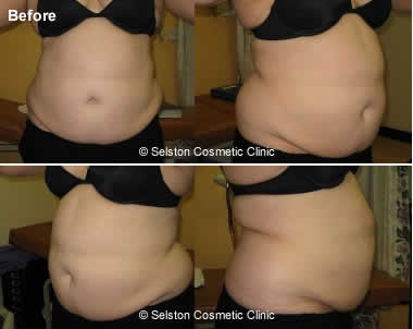 Vaser Lipo before
