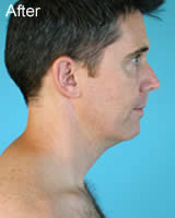Chin liposuction after photo