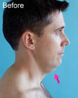 Chin liposuction before photo